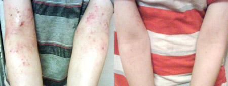Before & After Spraying i-H2O - Eczema